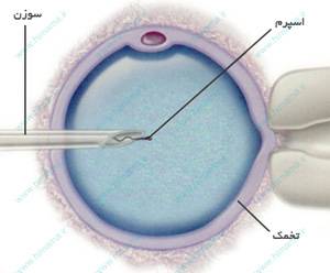 	تزریق اسپرم درون سیتوپلاسم 