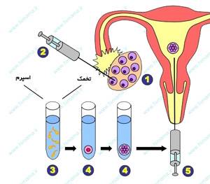 مراحل IVF